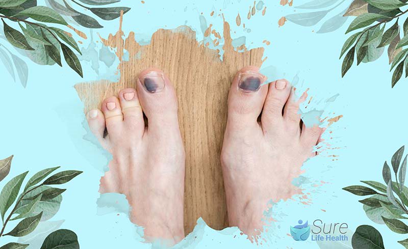 How to Heal a Bruised Toe Nail